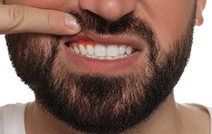 A bearded, grimacing man revealing his inflamed gums