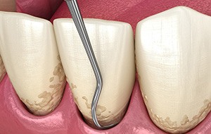 A 3D illustration of the scaling and root planing process
