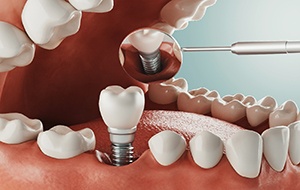 Diagram of a dental implant in Canonsburg inside the mouth