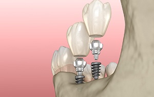 Diagram showing how dental implants work in Canonsburg