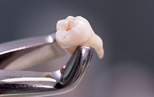 Metal clasp holding extracted tooth