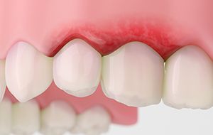Illustration of red, inflamed gums
