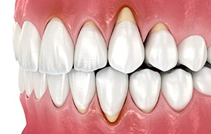 Illustration of receding gums