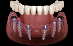 Digital illustration of implant dentures
