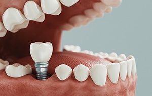 Man in dental chair holding jaw