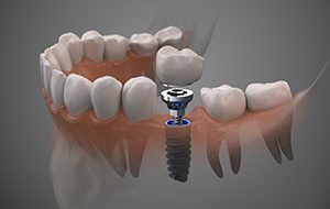 Diagram of a single tooth dental implant