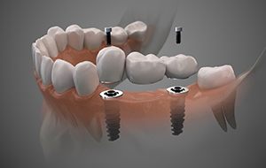Diagram of implant bridge for replacing multiple missing teeth