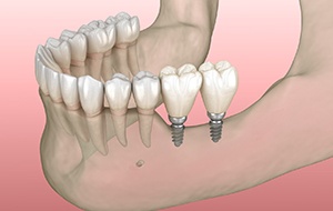 Diagram showing mini dental implants