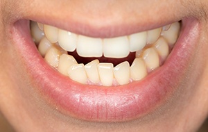 a person with crowded teeth smiling