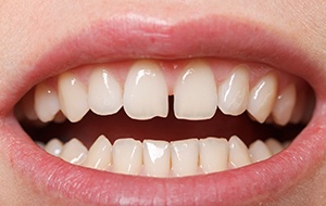 a person with a diastema