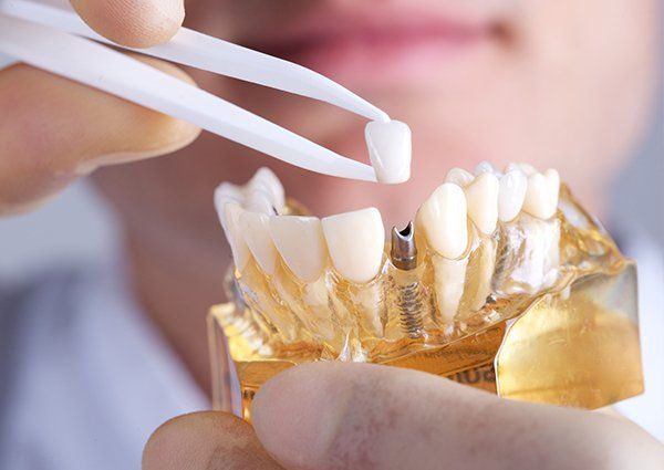 dental implant 3