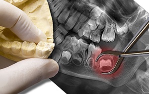 Model smile and x-rays of tooth to be extracted