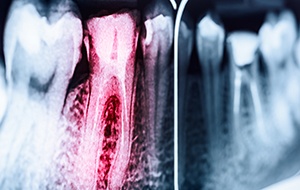 X-ray of root canal treated tooth