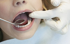 Closeup of child receiving dental exam