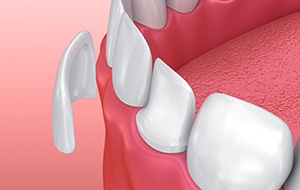 Animation of porcelain veneer placement