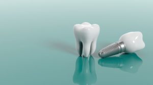 two dental implants compared