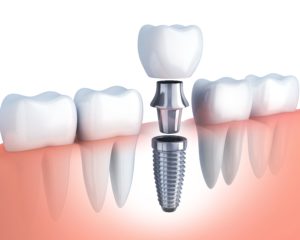 diagram of dental implant 