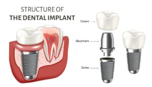 dental implants education poster illustration 