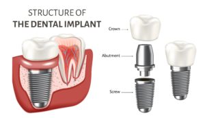 dental implants education poster illustration