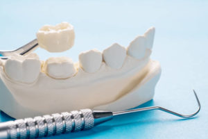 Model of a tooth prepared for a crown