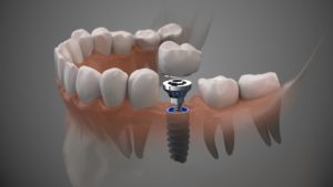 CGI of a dental implant screw with a crown floating over it in front of a gray background