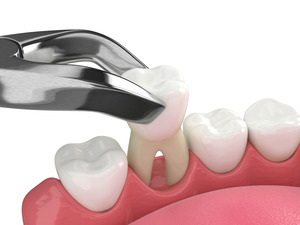 Illustration of a tooth extraction in the lower arch