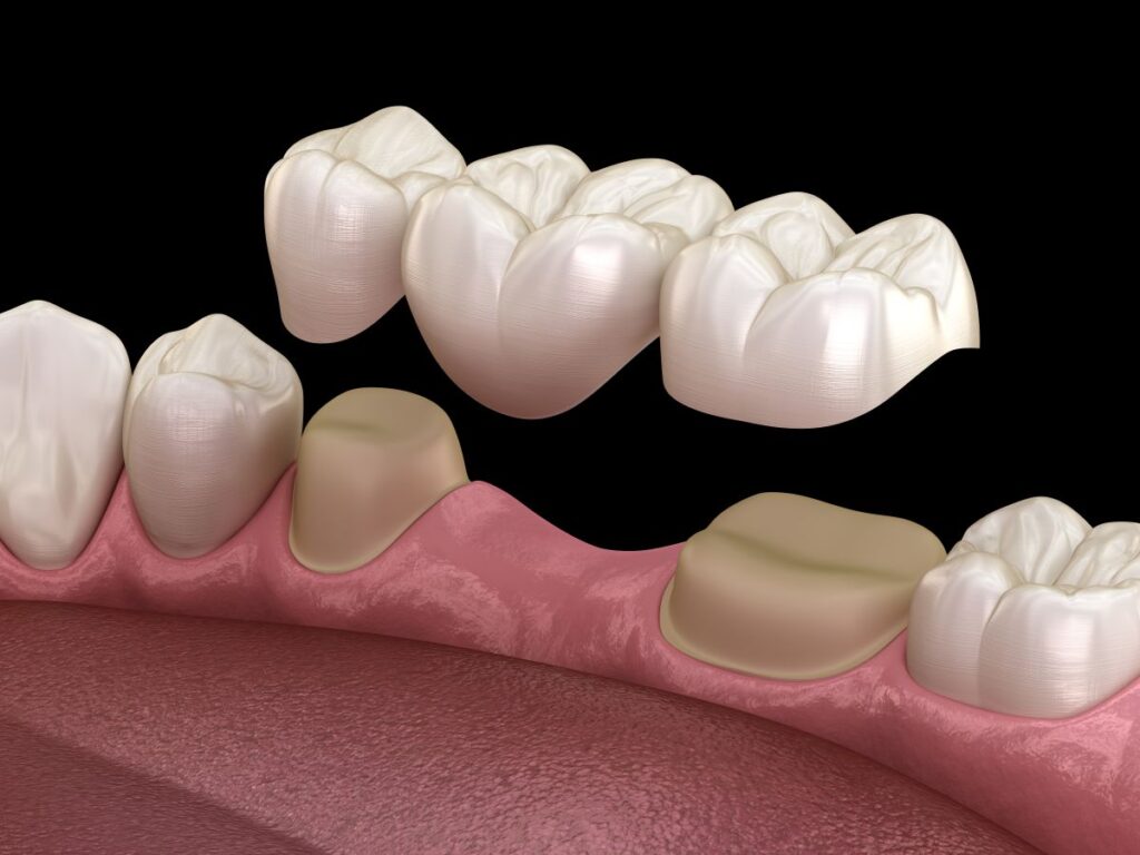 A CGI of a dental bridge.