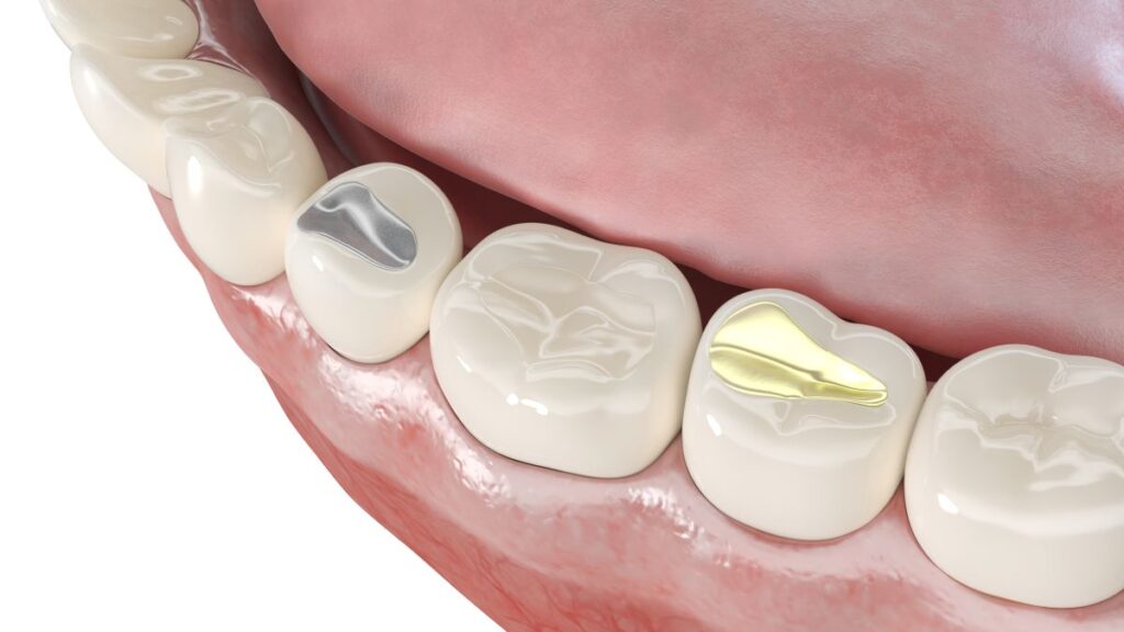 A CGI of teeth with different types of fillings